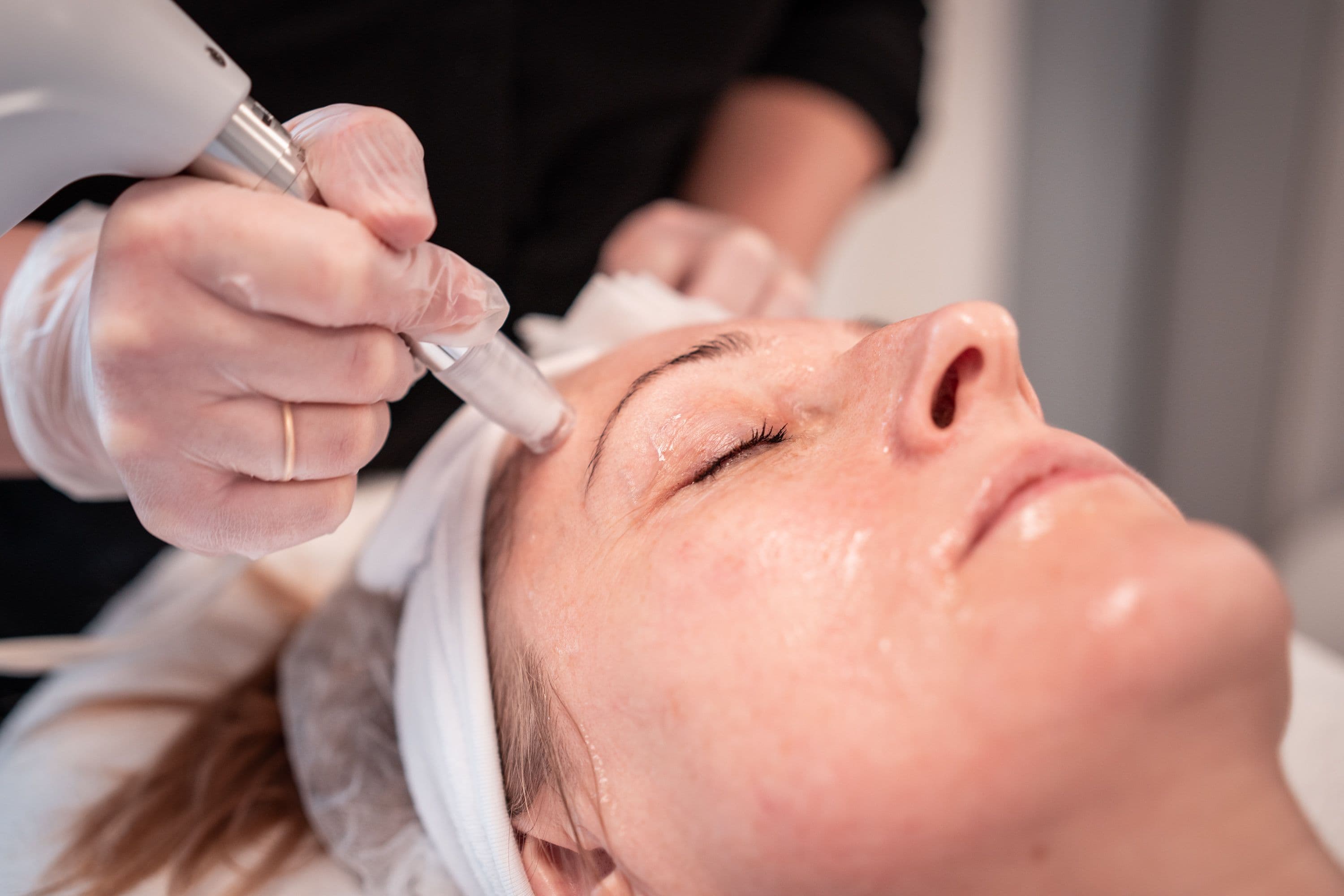 Microneedling behandling
